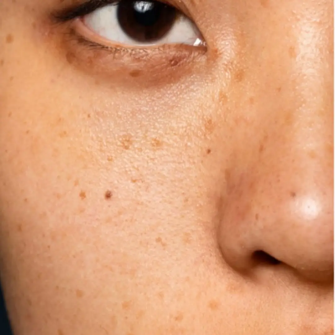 Dark Spots
