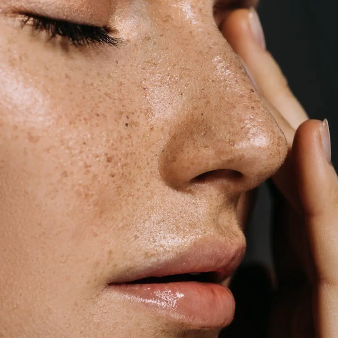 Uneven Skin Tone
